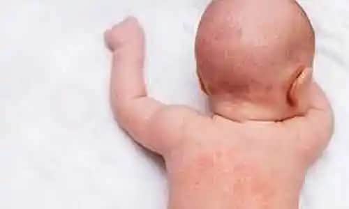 Çocuk Egzaması Hakkında Kapsamlı Bilgi ve Etkili Yönetim Yöntemleri