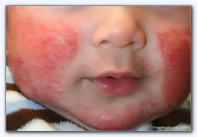 Çocuklarda Kafa Egzaması Nedenleri, Belirtileri ve Korunma Yöntemleri