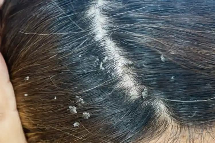 Çocuklarda Saç Egzaması: Belirtiler, Nedenler ve Etkili Bakım Yöntemleri