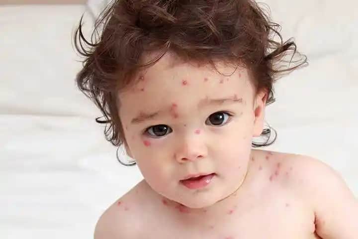 Çocuklarda Sivilce: Nedenleri, Korunma Yolları ve Etkili Tedavi Yöntemleri