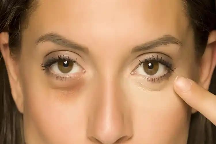 D vitamini eksikliği ve göz altı morlukları: cilt sağlığını etkileyen önemli faktörler