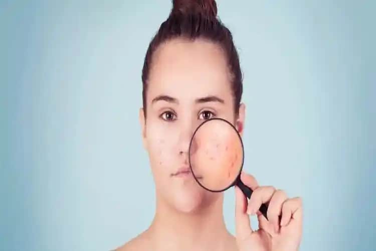 D Vitamini Eksikliği ve Sivilceler: Cilt Sağlığına Etkileri ve Korunma Yöntemleri