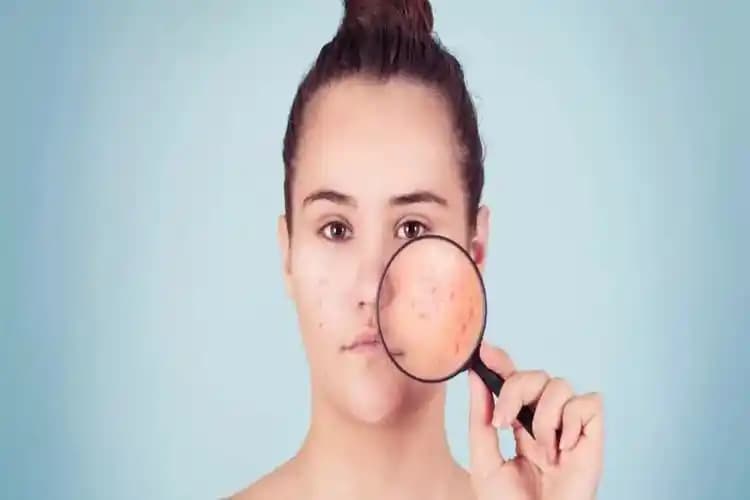 D Vitamini Eksikliği ve Sivilceler: Cilt Sağlığına Etkileri ve Korunma Yöntemleri