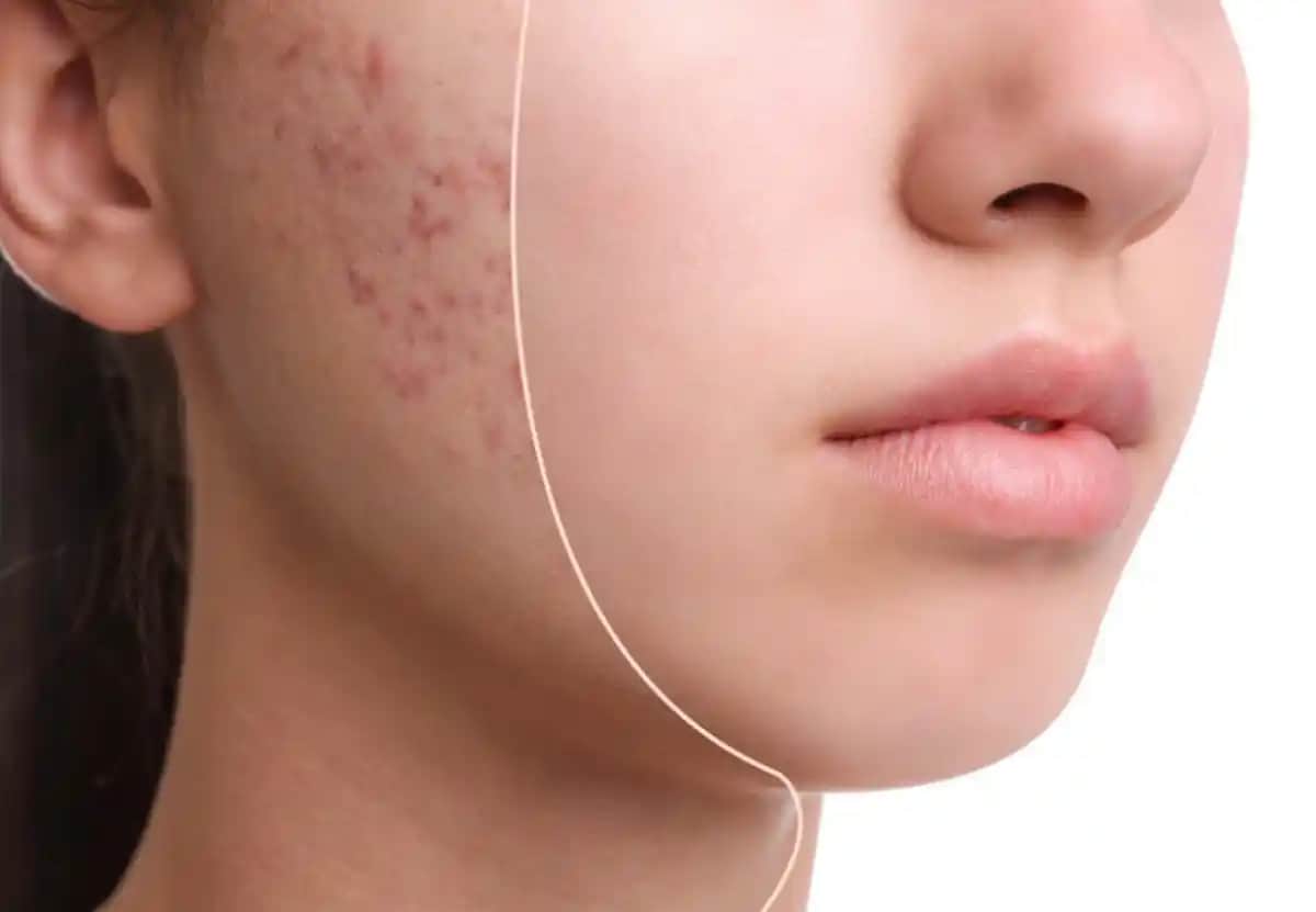 Deri Altı Akne Nedenleri, Belirtileri ve Etkili Tedavi Yöntemleri Rehberi