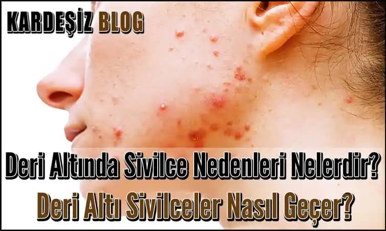 Deri Altı Şişlikleri ve Sivilceler: Belirtiler, Nedenler ve Korunma Yöntemleri