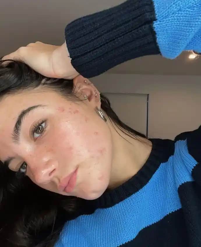 Deri Altı Sivilceleri Nasıl Geçer: Nedenleri ve Etkili Çözüm Yolları