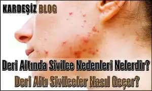 Deri Altında Beyaz Sivilce Nedenleri, Özellikleri ve Etkili Tedavi Yöntemleri