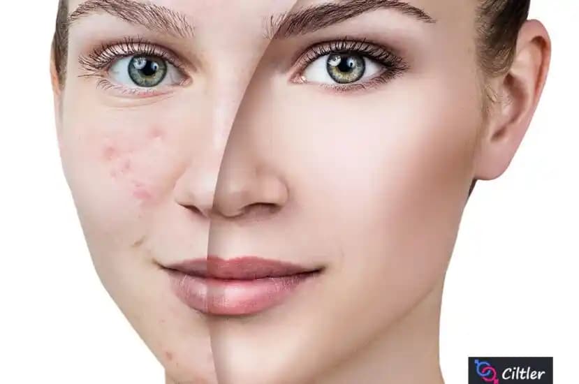 Deri Altında Çıkan Sivilcelerin Nedenleri ve Doğal Çözüm Yolları