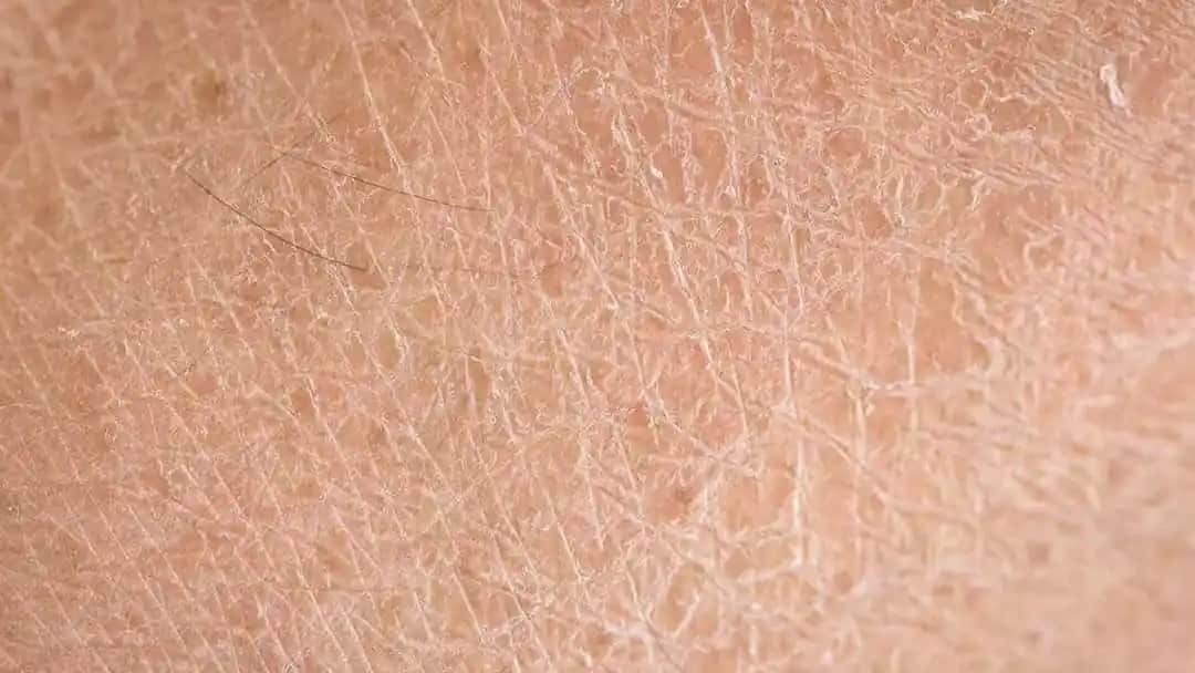 Deri Kuruluğu Nedenleri, Belirtileri ve Etkili Önleme Yöntemleri
