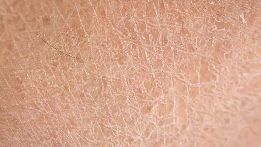 Deri Kuruluğu Nedenleri, Belirtileri ve Etkili Önleme Yöntemleri