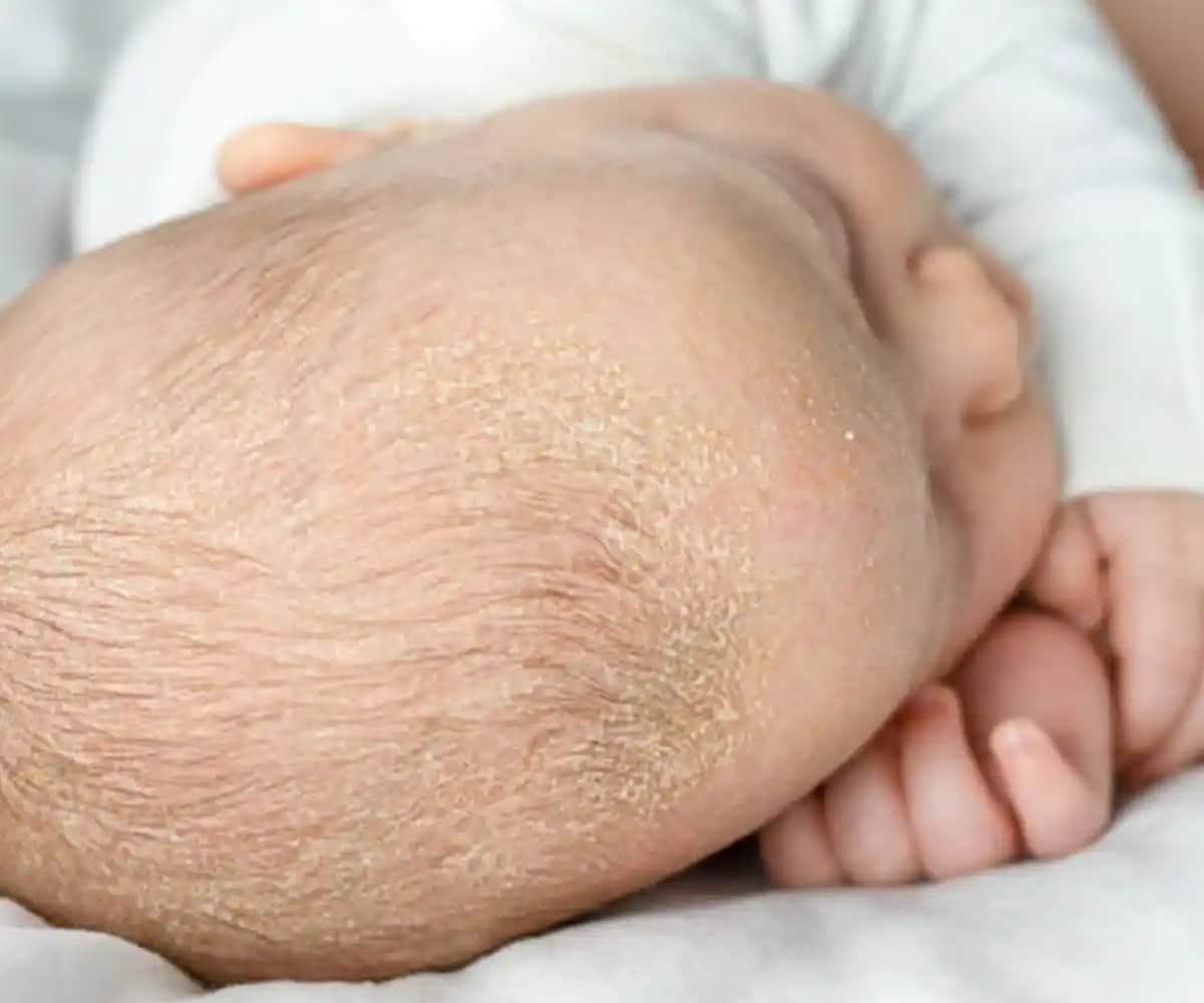 Deri Pullanmasının Nedenleri ve Cilt Sağlığını Koruma Yöntemleri