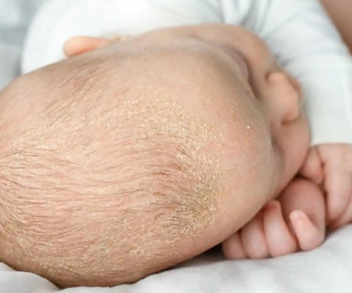 Deri Pullanmasının Nedenleri ve Cilt Sağlığını Koruma Yöntemleri