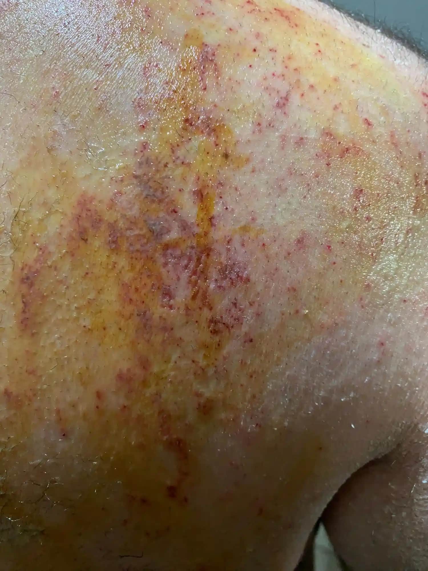 Deri Tahrişi ve Kozmetik Ürünler: Bilinçli Kullanımın Önemi ve Korunma Yolları