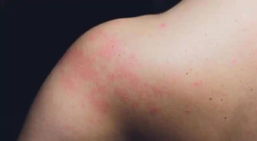 Deride Yanık Gibi Kızarıklık Nedenleri ve Etkili Önleme Yöntemleri