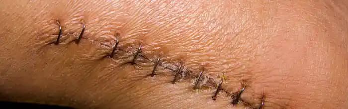 Dikiş Gerektiren Yaralar: Belirtileri, İlk Yardım ve Doğal Tedavi Yöntemleri