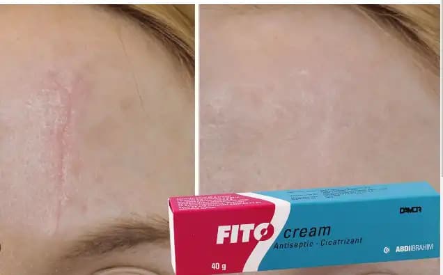 Dikiş Sonrası Krem Kullanımı ve Doğru Bakım Adımları