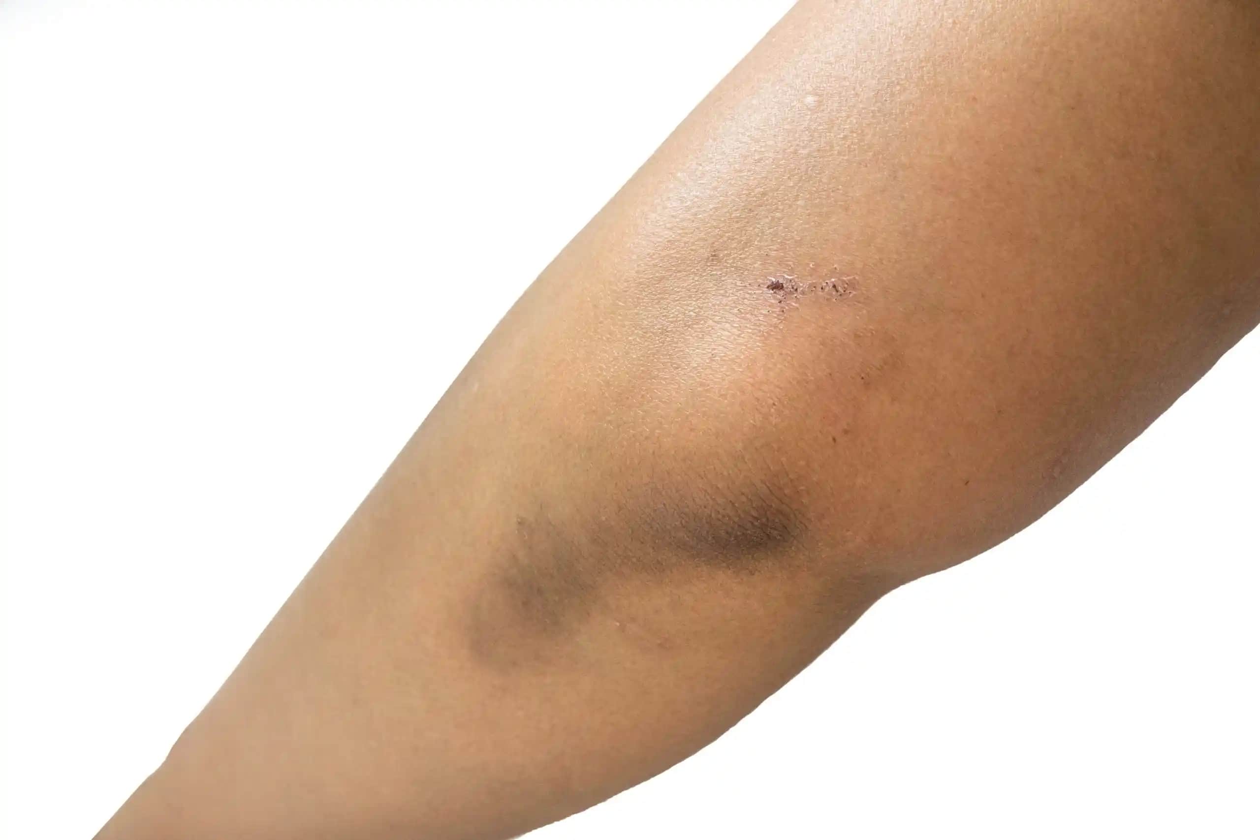 Dirsek Kararmasının Nedenleri ve Etkili Çözüm Yolları