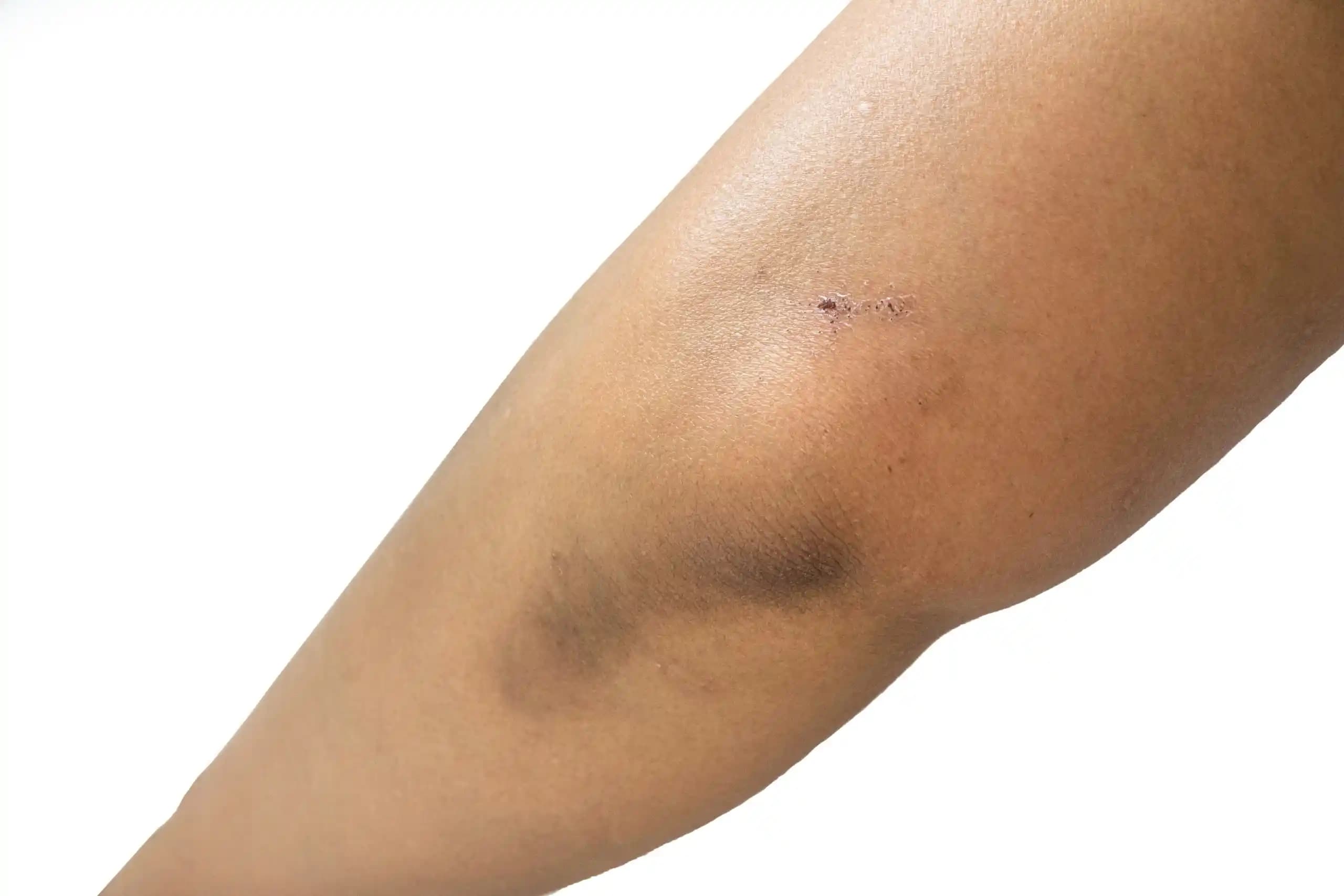 Dirsek Kararmasının Nedenleri ve Etkili Çözüm Yolları