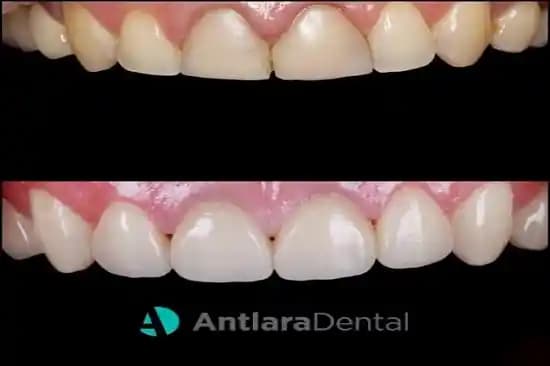 Diş Diplerindeki Sarı Lekeler: Nedenleri ve Etkili Kozmetik ile Doğal Çözüm Yöntemleri