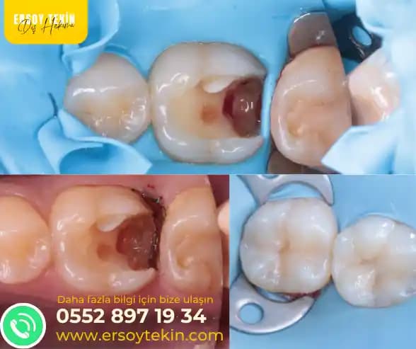 Diş Dolgusu Fiyatları ve Malzeme Seçenekleri Hakkında Bilmeniz Gerekenler