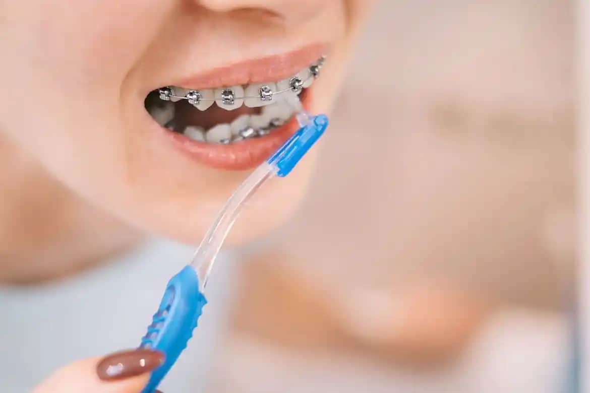 Diş Teli Takarken Doğru Fırça Seçimi ve Temizlik İpuçlarıyla Ağız Sağlığınızı Koruyun