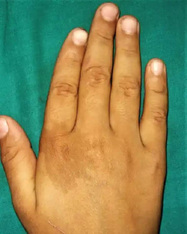 Dişte Kahve Lekeleri Nedenleri, Çözüm Yolları ve Koruma İpuçları