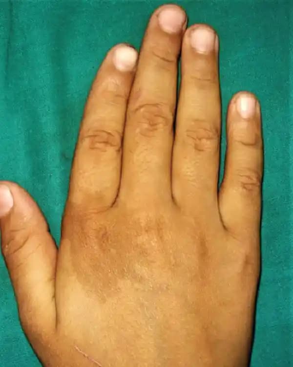 Dişte Kahve Lekeleri Nedenleri, Çözüm Yolları ve Koruma İpuçları