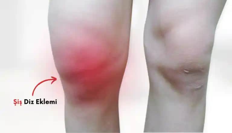 Dizde Kararma Nedenleri ve Etkili Çözüm Yöntemleri Hakkında Kapsamlı Rehber