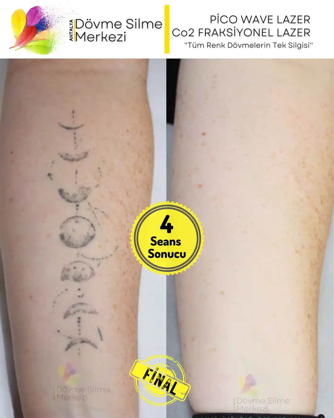 Dövme Sonrası Alkol Tüketimi ve İyileşme Sürecinde Dikkat Edilmesi Gerekenler