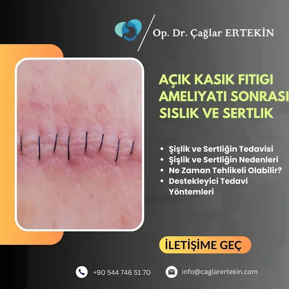 Dövme Sonrası Şişlik ve Kızarıklık: Doğru Bakım ve Önlemlerle Sağlıklı İyileşme