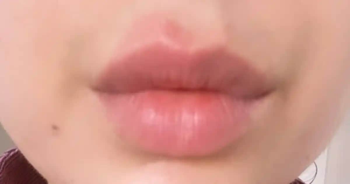 Dudak Altı Kızarıklığı Nedenleri, Belirtileri ve Etkili Bakım Yöntemleri