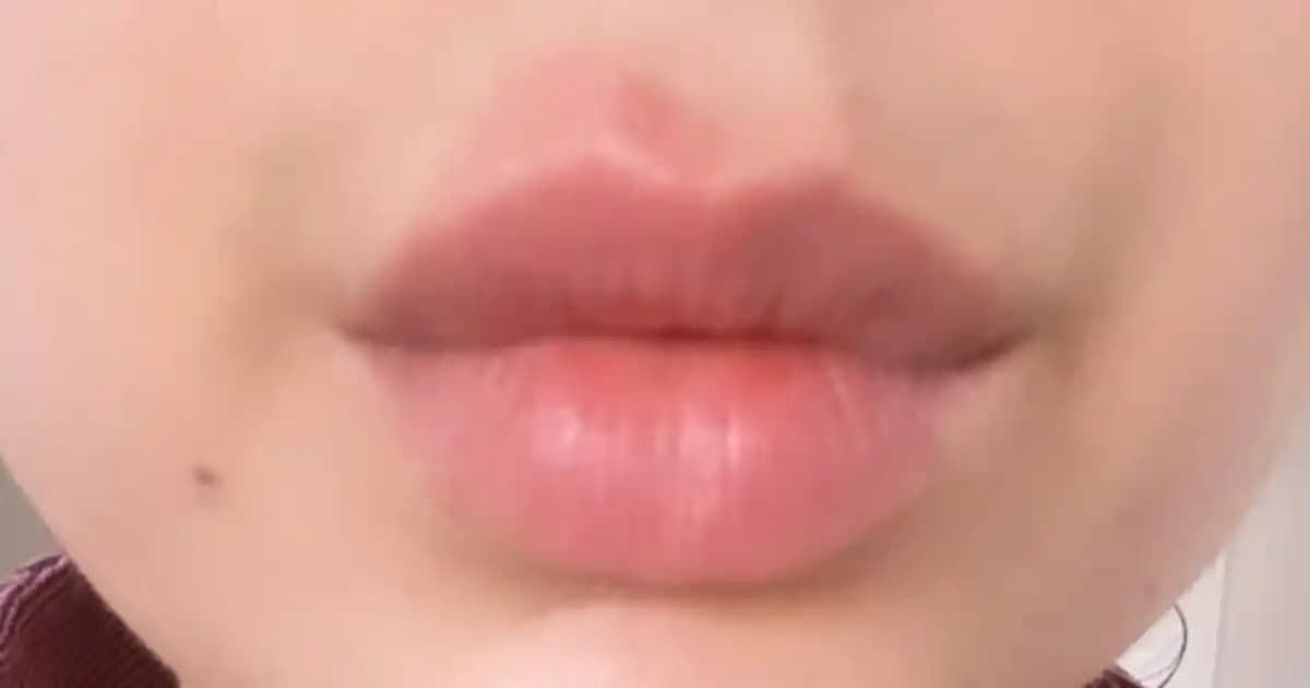 Dudak Altı Kızarıklığı Nedenleri, Belirtileri ve Etkili Bakım Yöntemleri