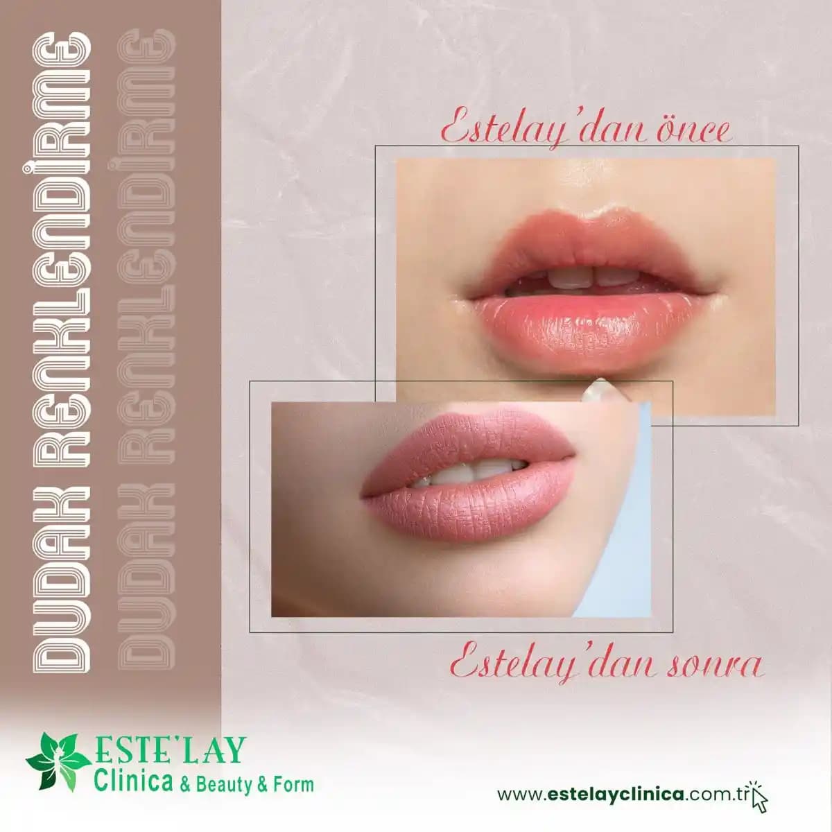 Dudak Çerçevesi Nedir? Estetik ve Doğallık İçin Uygun Yöntemler ve Trendler
