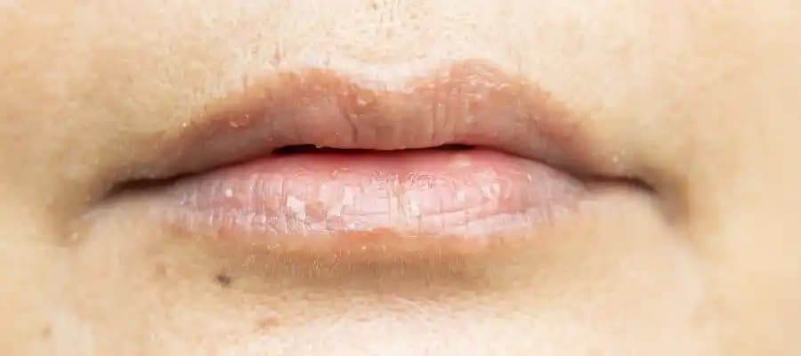 Dudak Çevresi Kararmasının Nedenleri ve Etkili Çözüm Yöntemleri