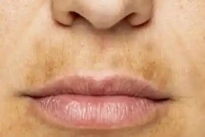 Dudak Lekeleri Nedenleri Türleri ve Etkili Çözüm Yolları Hakkında Kapsamlı Bilgi
