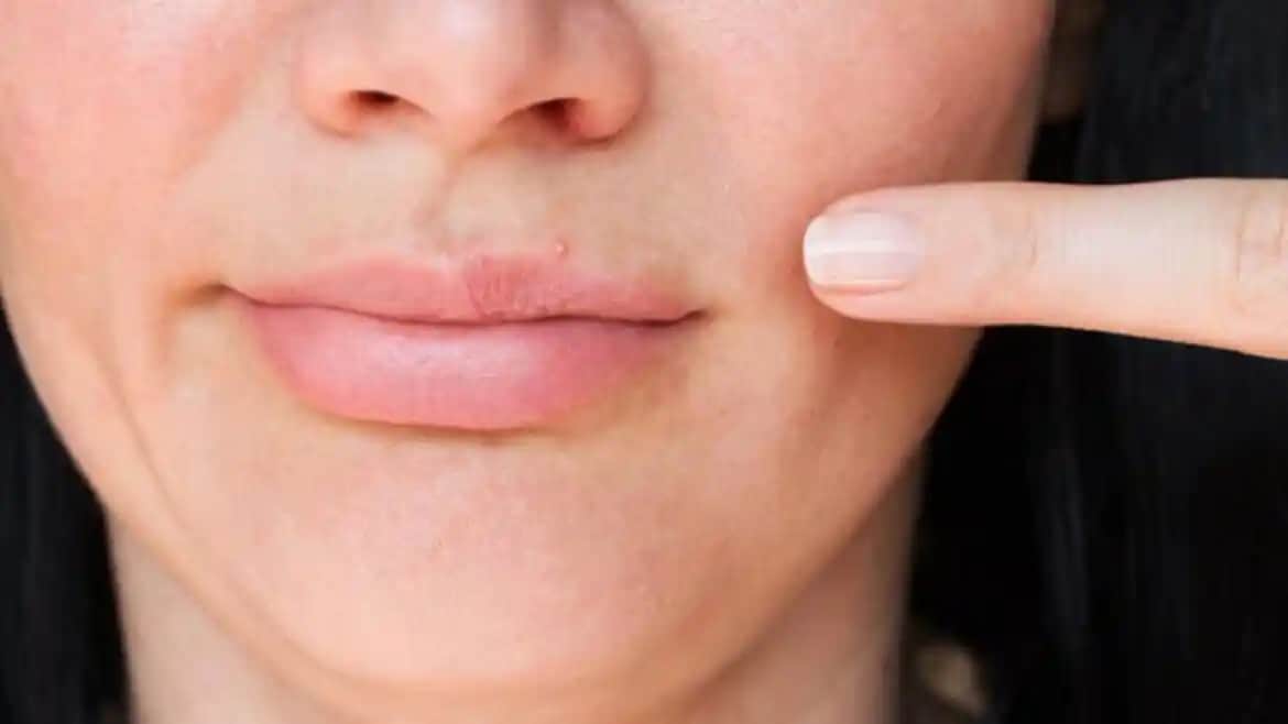 Dudak Üstü Egzama Nedir, Nedenleri ve Etkili Bakım Yöntemleri Hakkında Kapsamlı Rehber