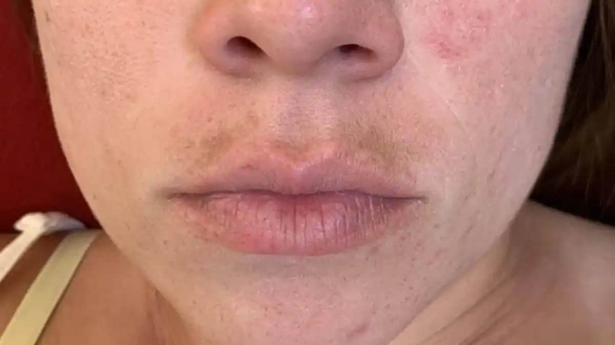 Dudak Üstü Kararması Nedenleri, Koruma Yöntemleri ve Tedavi Seçenekleri