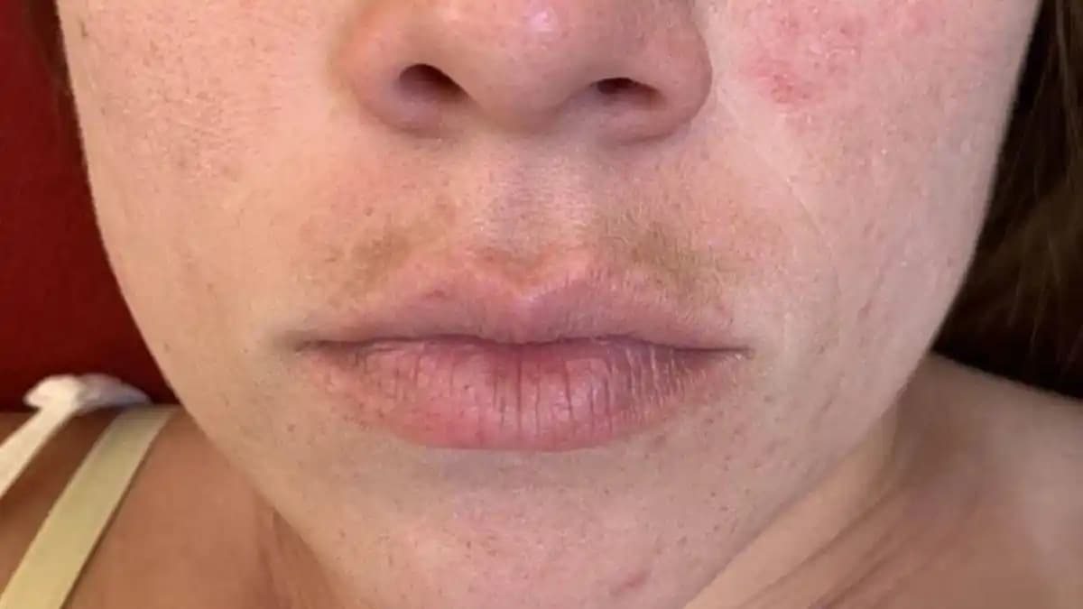 Dudak Üstü Kararması Nedenleri, Koruma Yöntemleri ve Tedavi Seçenekleri