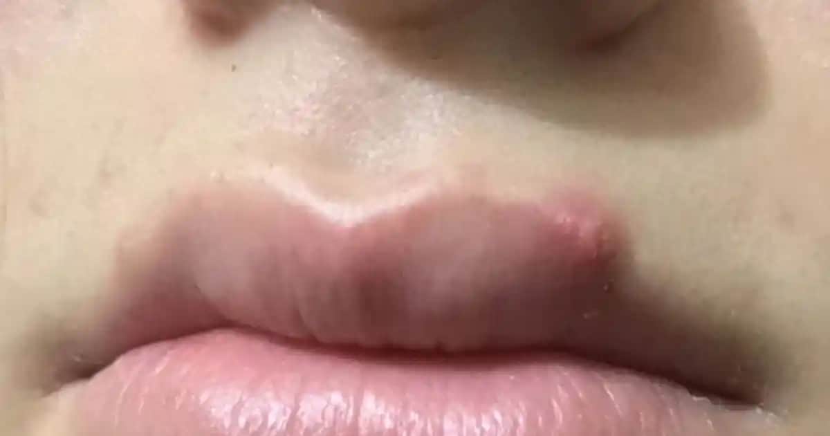 Dudak Üstünde Siyah Nokta Nedenleri ve Etkili Çözüm Yolları Rehberi