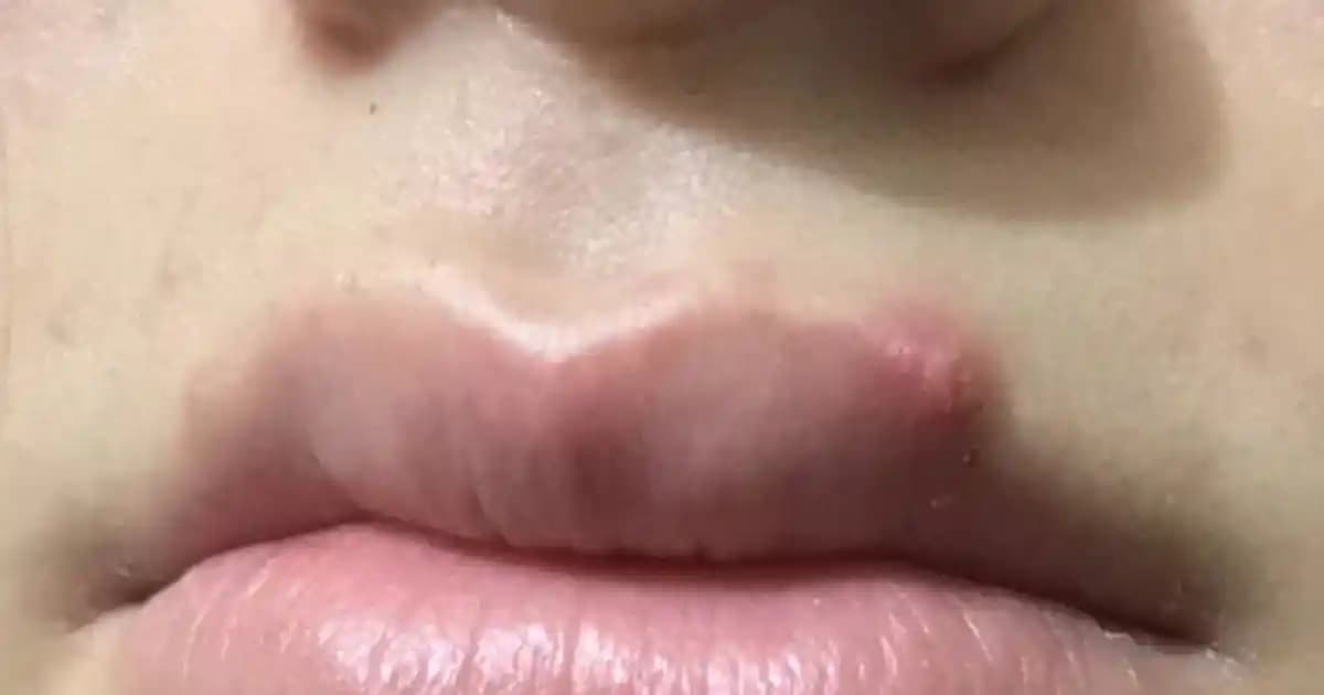 Dudak Üstünde Siyah Nokta Nedenleri ve Etkili Çözüm Yolları Rehberi