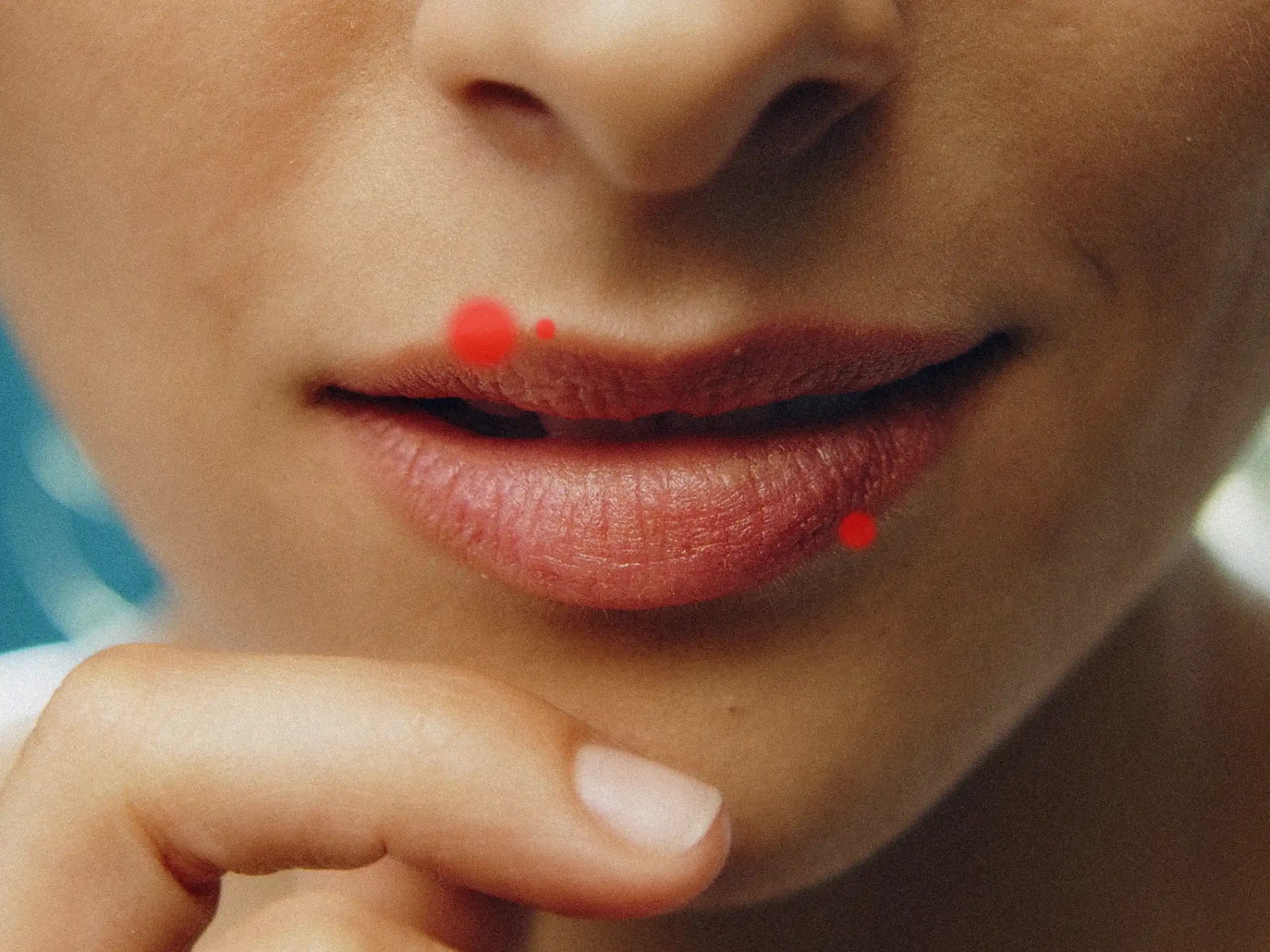 Dudak Yanındaki Sivilceler Neden Oluşur ve Doğru Bakım Yöntemleri