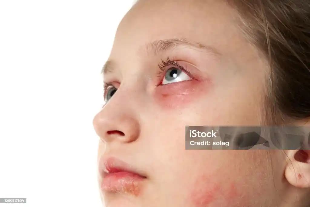 Dudaklarda Kızarıklık Nedenleri ve Etkili Bakım Yöntemleri Hakkında Bilgiler