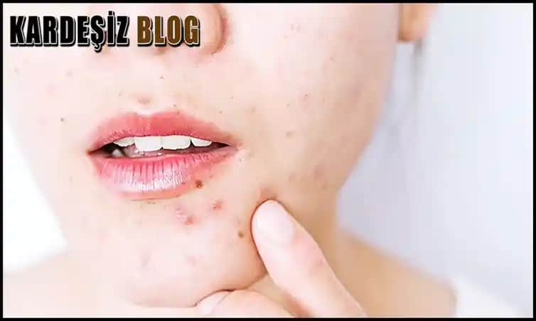 Dudaklarda Sivilce Nedenleri, Önlemler ve Doğal Çözüm Yöntemleri