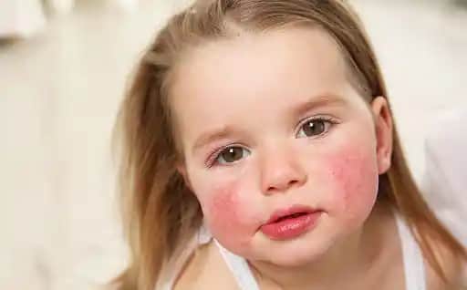 Duştan Sonra Yüz Kızarmasının Nedenleri ve Etkili Çözüm Yolları