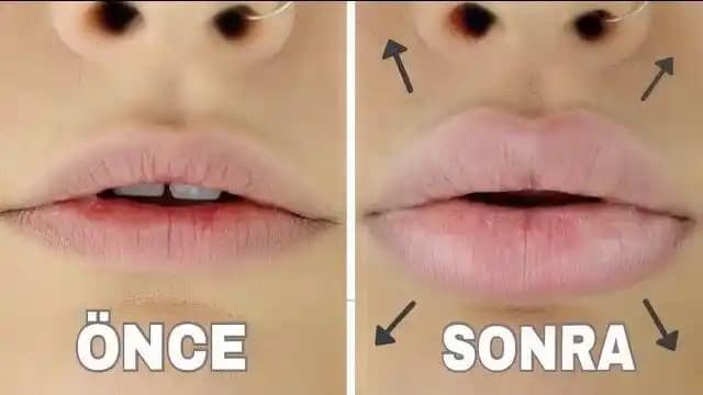 Düşük Dudakların Düzeltilmesi İçin Estetik Yaklaşımlar ve Güncel Çözüm Yolları