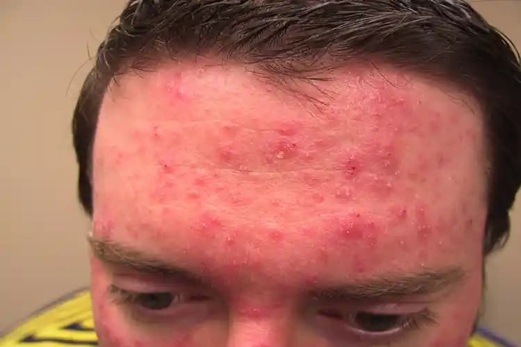 E Vitamini ve Sivilce İlişkisi: Doğru Kullanım ve Bilinen Yanlışlar