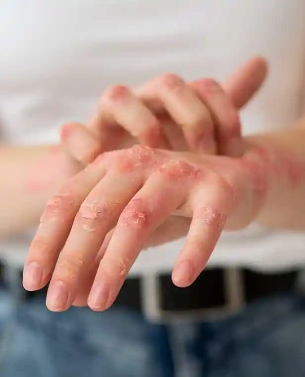 Egzama Atağı Nedir, Belirtileri ve Önleme Yöntemleri Hakkında Bilgiler