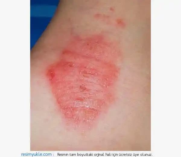 Egzama Çeşitleri ve Cilt Sağlığı İçin Bilmeniz Gerekenler