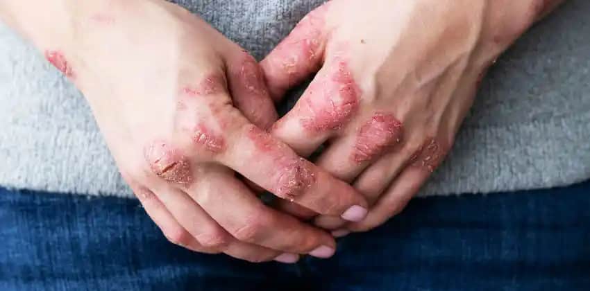 Egzama Hastalığı ve Cilt Bakımında Doğru Yaklaşımlar