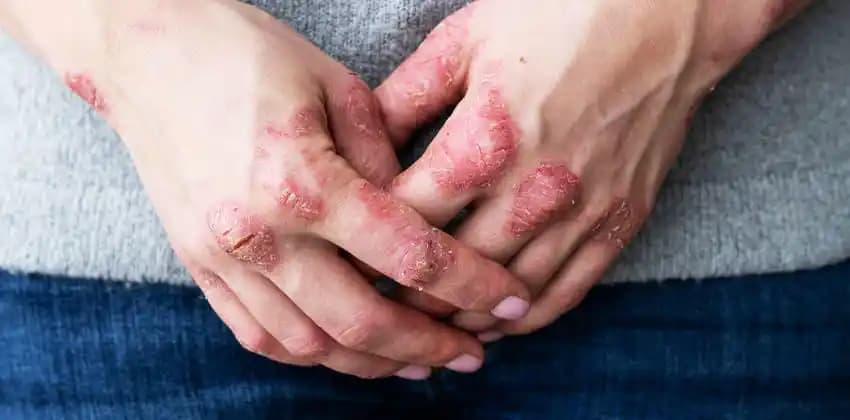 Egzama Hastalığı ve Cilt Bakımında Doğru Yaklaşımlar